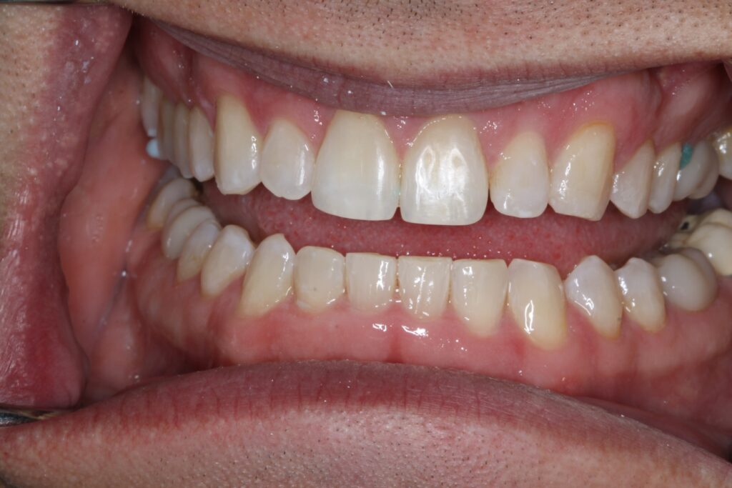 Smile Gallery. Dentist in Cedar Hills, UT. Dr. Brian E. Isaacson, DMD. Cedar Hills Family Dentistry