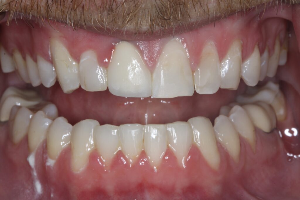 Smile Gallery. Dentist in Cedar Hills, UT. Dr. Brian E. Isaacson, DMD. Cedar Hills Family Dentistry