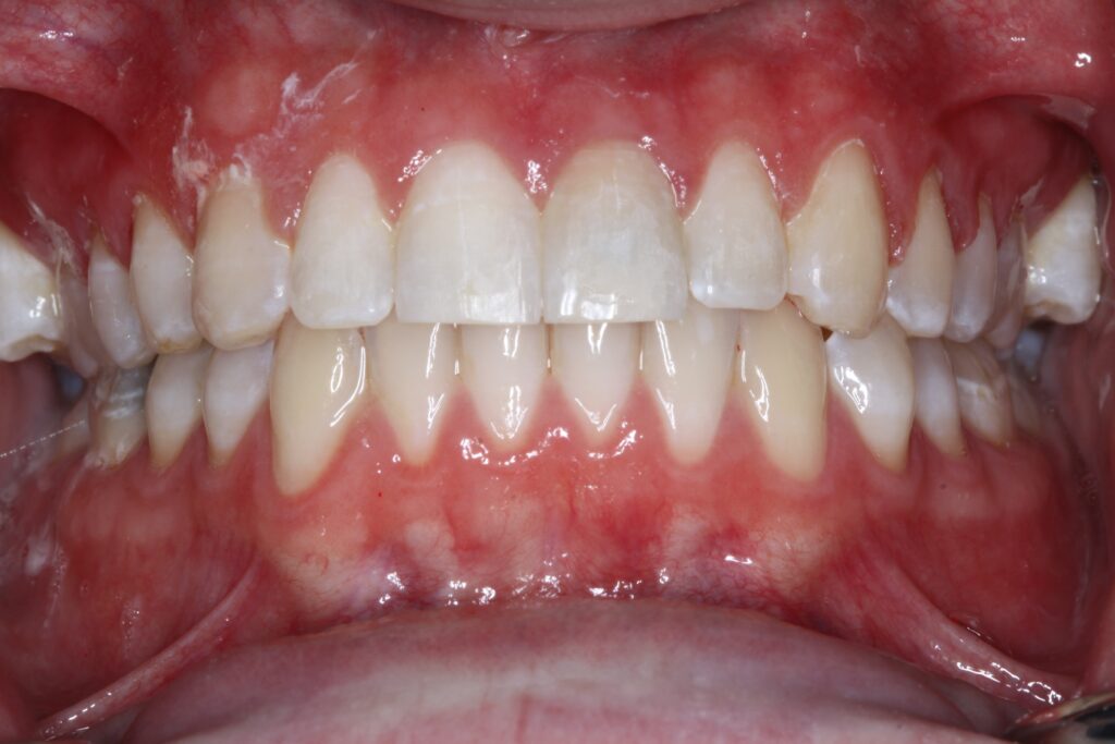 Smile Gallery. Dentist in Cedar Hills, UT. Dr. Brian E. Isaacson, DMD. Cedar Hills Family Dentistry