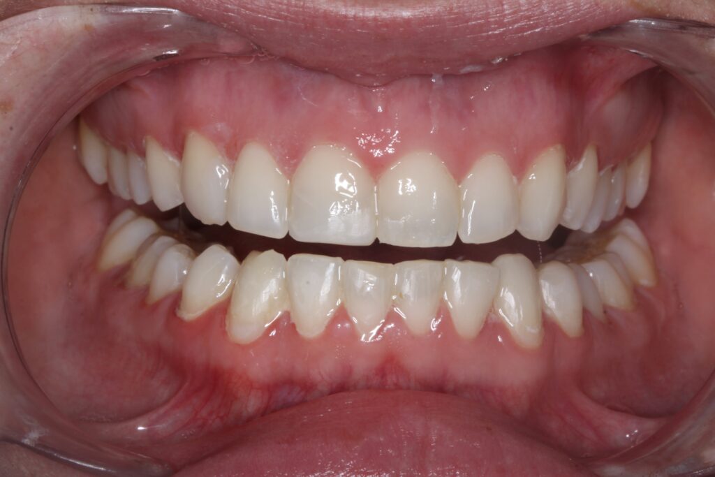 Smile Gallery. Dentist in Cedar Hills, UT. Dr. Brian E. Isaacson, DMD. Cedar Hills Family Dentistry