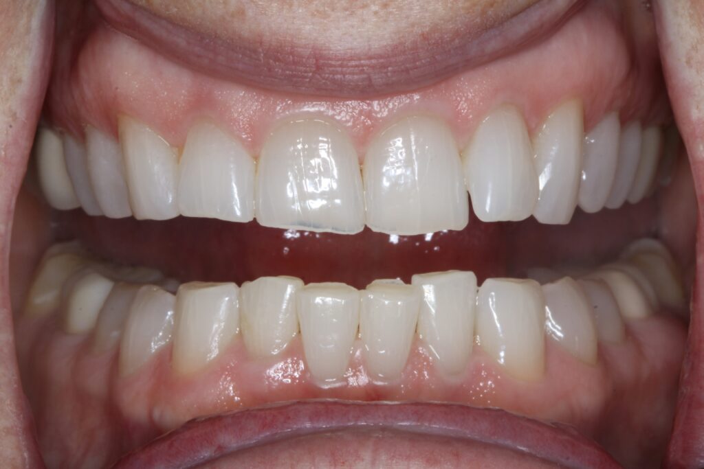 Smile Gallery. Dentist in Cedar Hills, UT. Dr. Brian E. Isaacson, DMD. Cedar Hills Family Dentistry