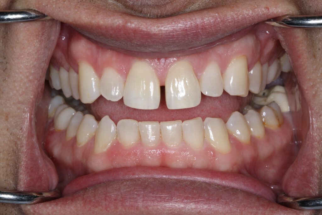 Smile Gallery. Dentist in Cedar Hills, UT. Dr. Brian E. Isaacson, DMD. Cedar Hills Family Dentistry