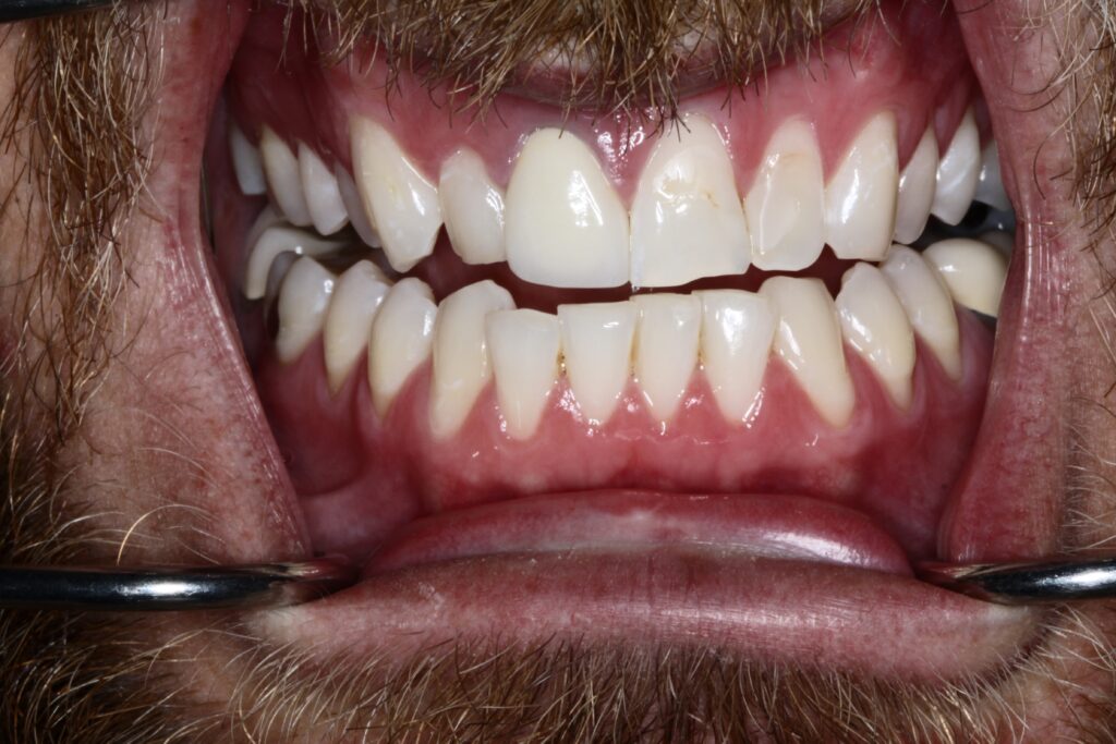 Smile Gallery. Dentist in Cedar Hills, UT. Dr. Brian E. Isaacson, DMD. Cedar Hills Family Dentistry
