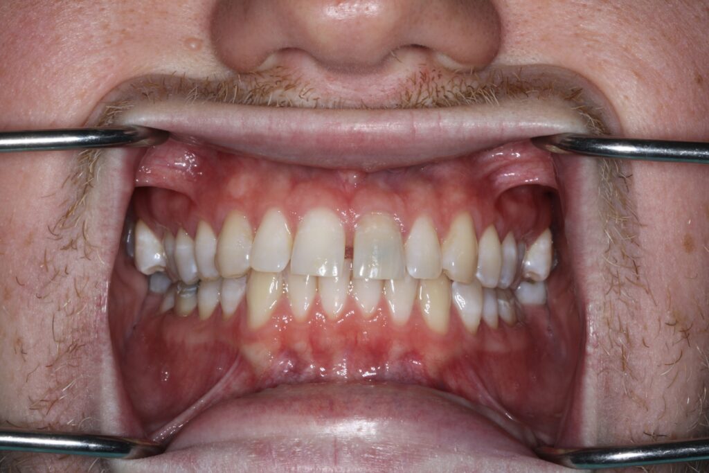 Smile Gallery. Dentist in Cedar Hills, UT. Dr. Brian E. Isaacson, DMD. Cedar Hills Family Dentistry