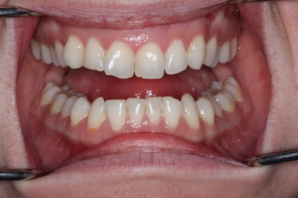 Smile Gallery. Dentist in Cedar Hills, UT. Dr. Brian E. Isaacson, DMD. Cedar Hills Family Dentistry
